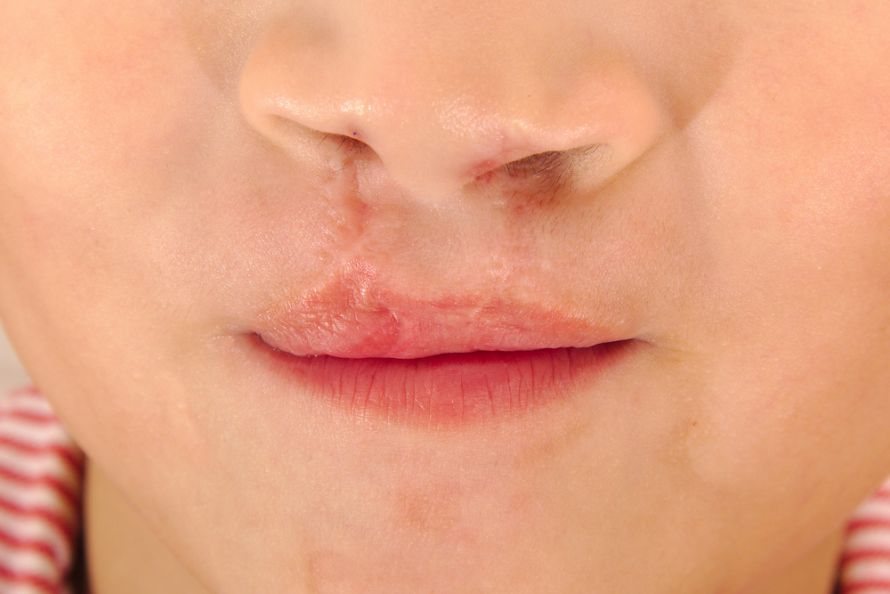 Eine gelungene Behandlung der Lippen-Gaumen-Spalte