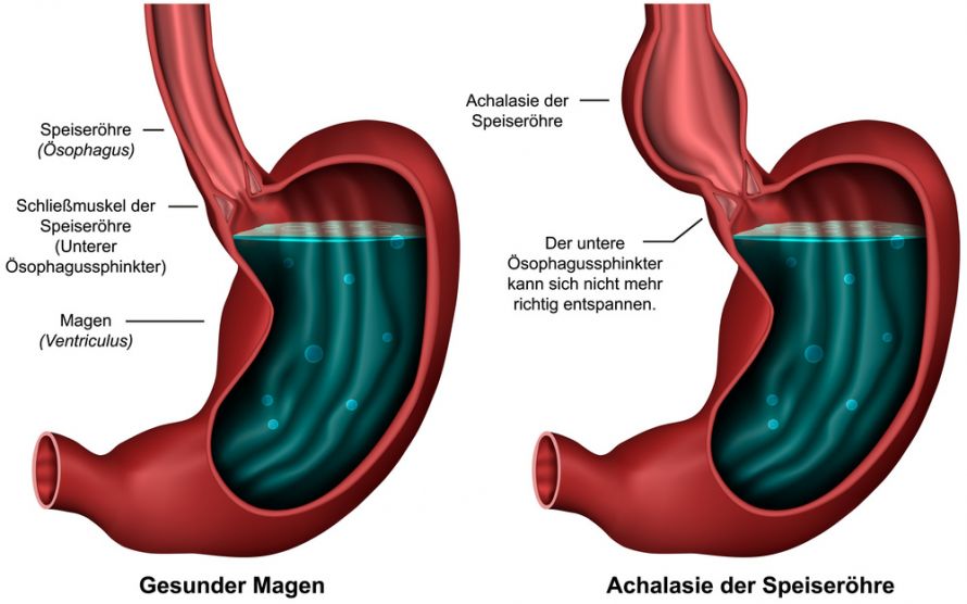 Achalasie der Speiseröhre