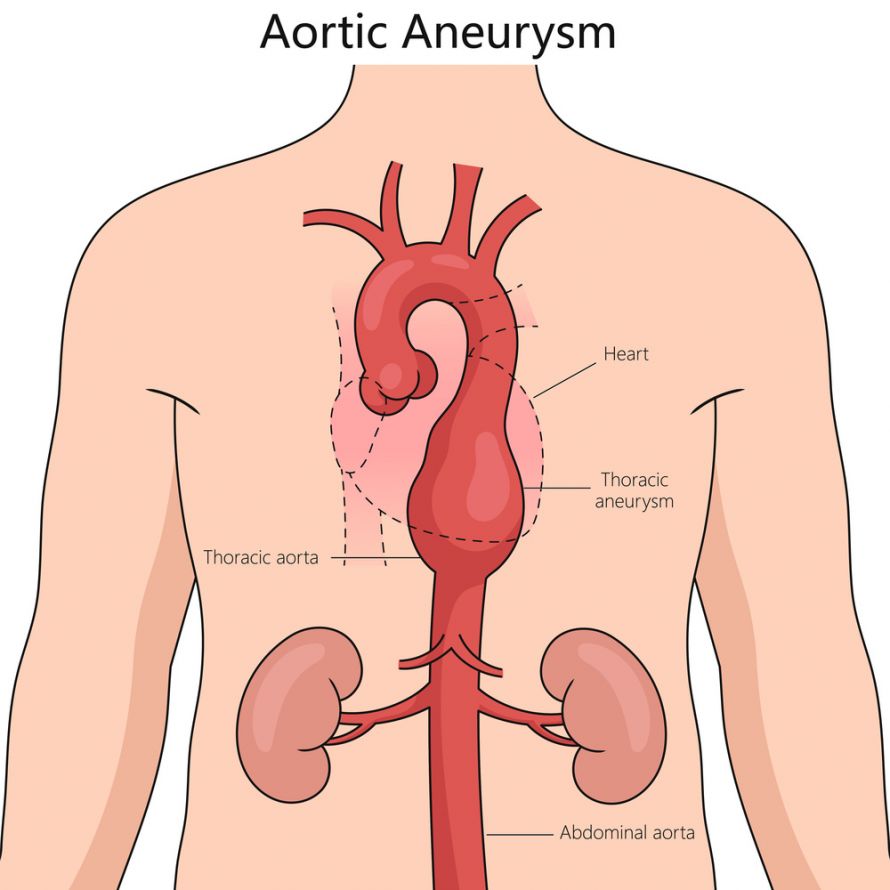 Aortenaneurysma