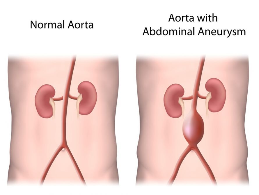 Vergleich normale Aorta und Aortenaneurysma