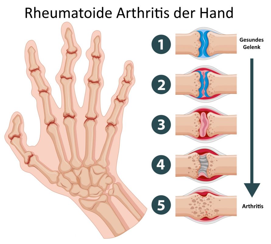 A kenőcs a rheumatoid arthritis kezelésére szolgál. Hatékony kenőcs kezelésére arthritis