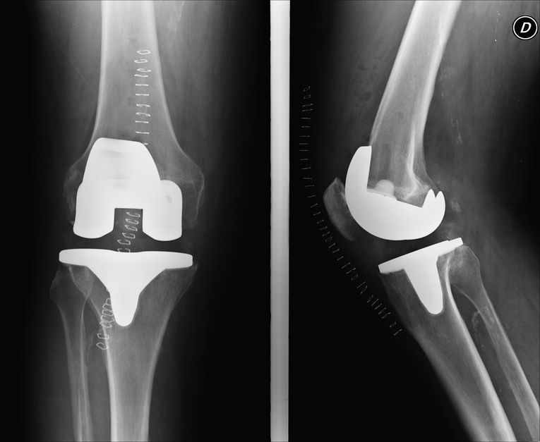 Knie-TEP im Röntgenbild