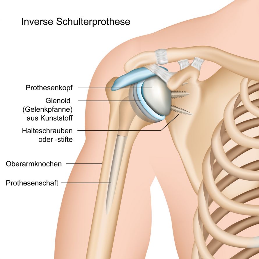 Inverse Schulterprothese