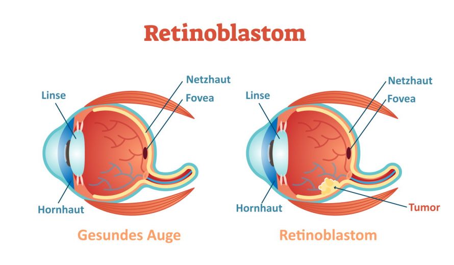 Retinoblastom