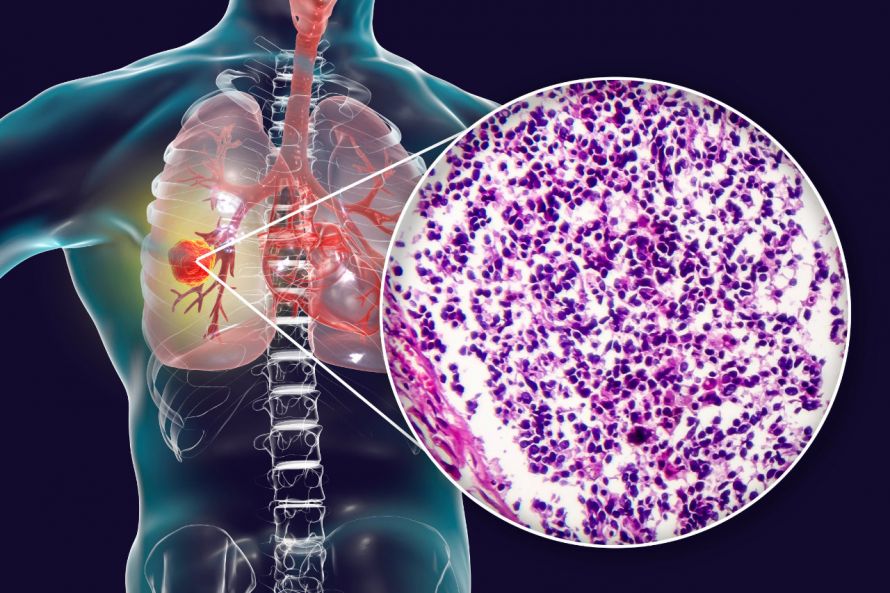 Lungenkrebs im histologischen Befund