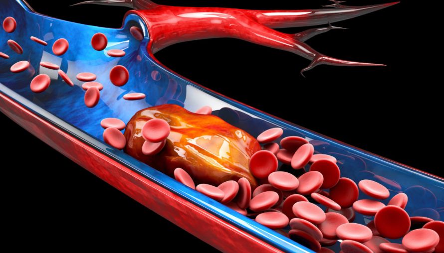 Thrombose: Ein Blutgerinnsel verstopft eine Vene