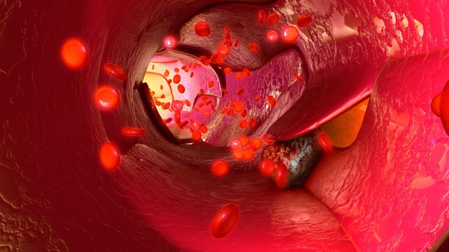 Tumorzellen in Blutgefäßen