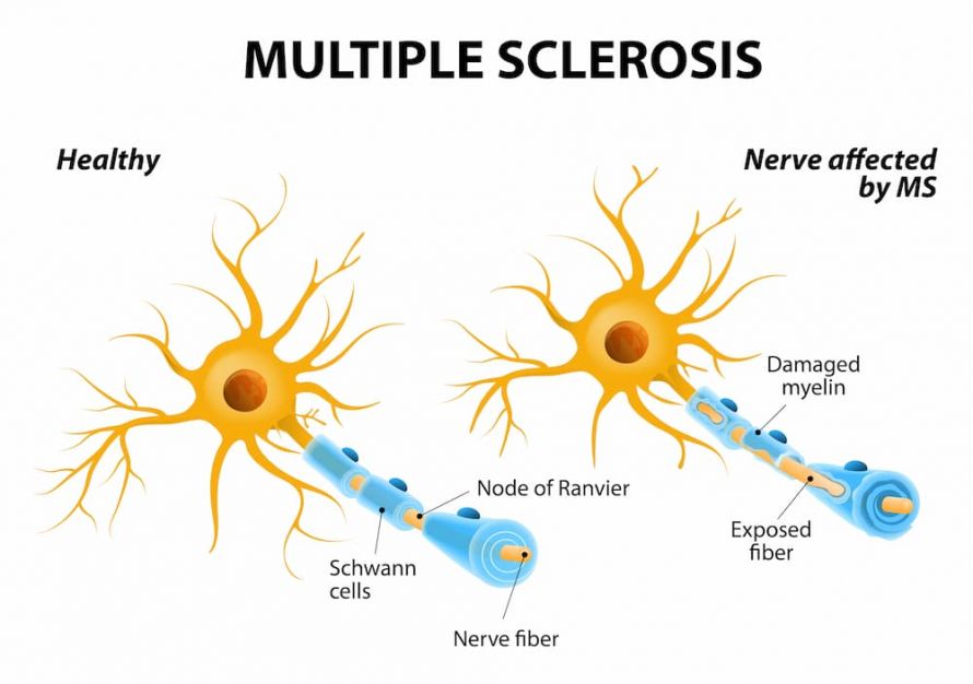 Angegriffene Nervenfasern bei Multiple Sklerose