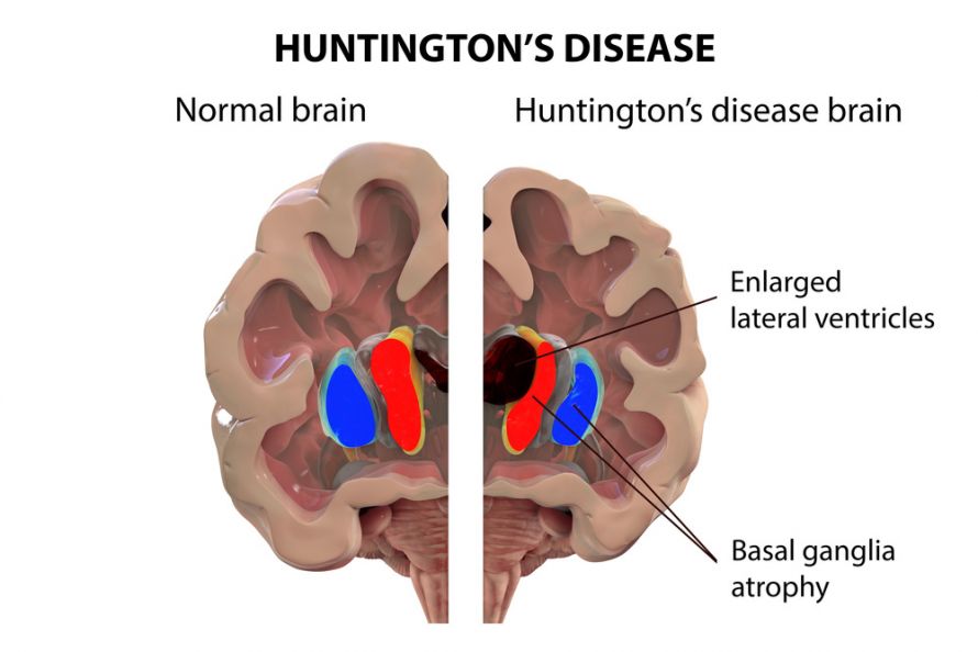 Skizze eines Gehirns mit Chorea Huntington