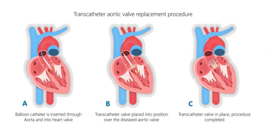 Ablauf der TAVI (Transkatheter-Aortenklappen-Implantation) 
